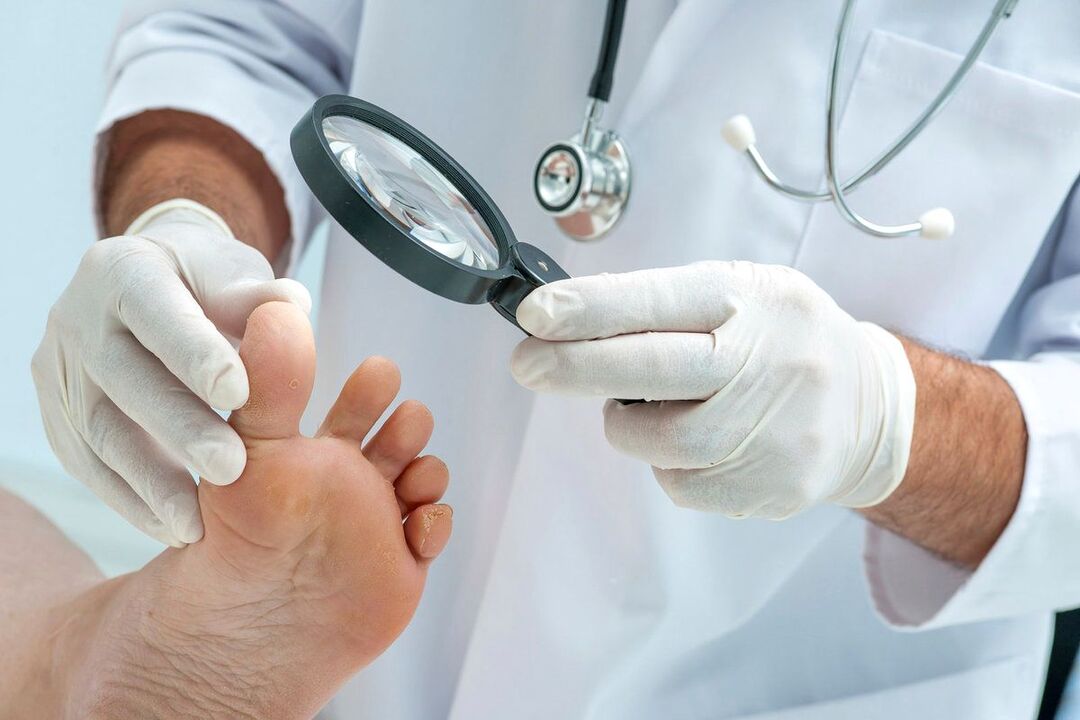zdravnik pregleda stopala z glivicami