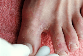 simptomi glivic na nogah