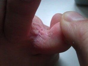 kožne lezije med prsti z glivicami
