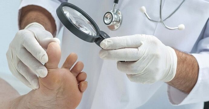 zdravnik pregleda noge na glivicah na nohtih