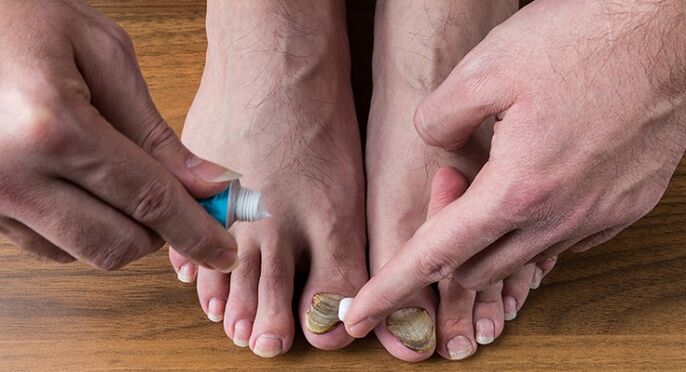 zdravljenje glivic na nohtih na nogah
