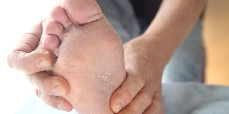 kožne lezije z glivicami na nogah