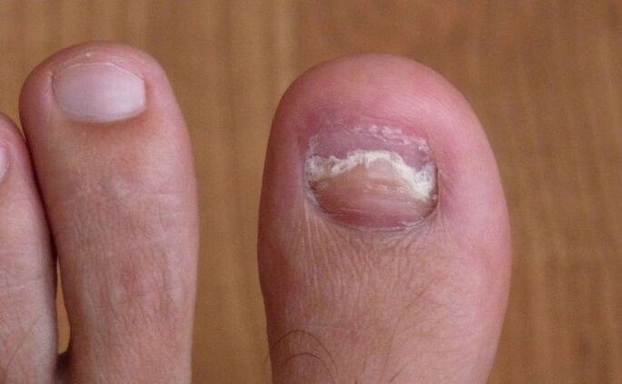 poškodba nohta na velikem prstu na nogi z glivicami