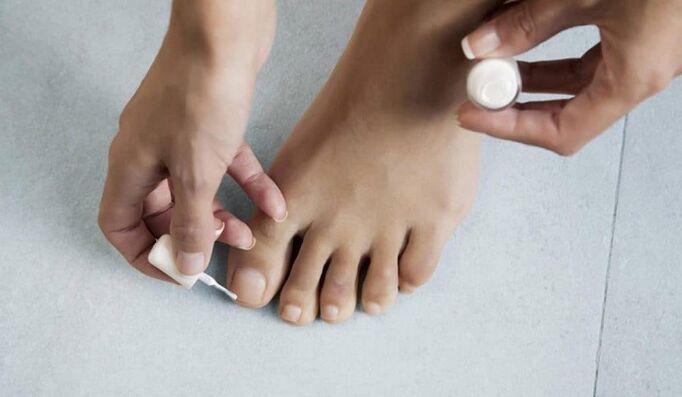 zdravljenje glivic na palcu na nogi z lakom