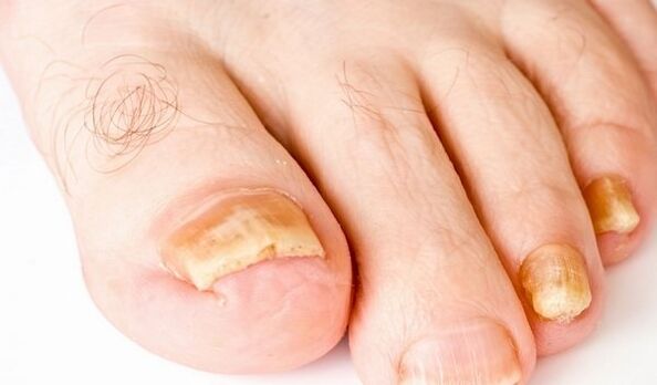fotografija simptomov glivic na nohtih na nogah