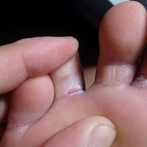 razpoka med prsti simptomi glive